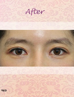 韩国cherish整形医院双眼皮+开眼角手术照片