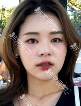 韩国优雅人全肋骨隆鼻初鼻案例分享,包含福鼻矫正+缩鼻翼