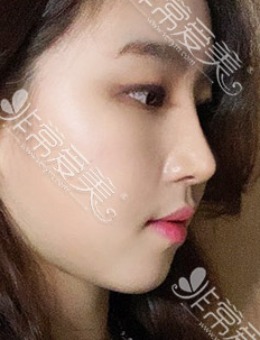 韩国优雅人整形驼峰鼻矫正手术+面吸2个月恢复案例