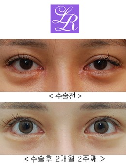 韩国来丽整形眼提肌+后眼角下至修复案例