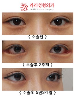 韩国来丽整形后眼角修复，5年3个月恢复照！