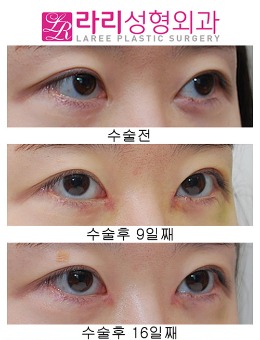 韩国来丽整形开眼角疤痕修复4年8个月照片
