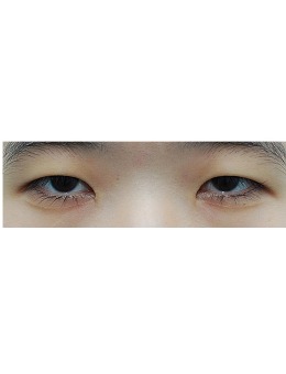 -韩国来丽整形双眼皮+开眼角手术照片