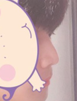 韩国玉芭uber男士隆鼻整形照片