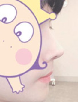 韩国玉芭uber男士隆鼻整形照片