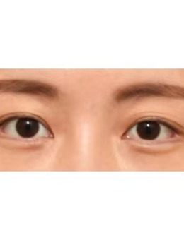 韩国icon整形医院双眼皮修复照片_术前