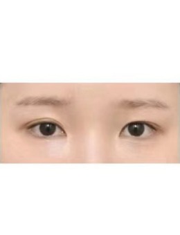 韩国icon埋线双眼皮+开眼角前后对比图_术前