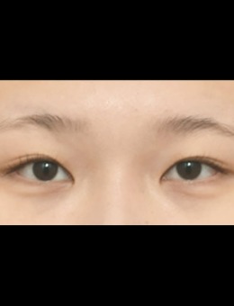 -韩国icon整形医院双重埋线法加宽双眼皮线条案例