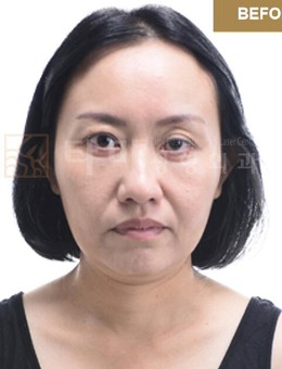 韩国她美整形医院全脸面部年轻化+隆胸手术照片曝光,年轻十岁不是梦！_术前