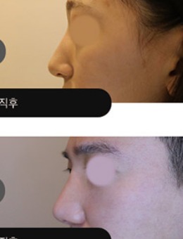 韩国吴佳娜皮肤科玻尿酸隆鼻照片
