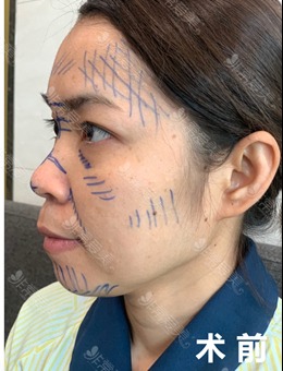 -韩国德丽珍医院图文解析：鼻综合和面部脂肪填充一起做危险吗