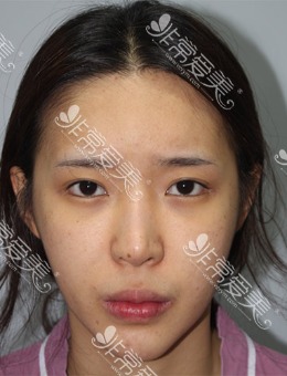 韩国现代美学开眼角+隆鼻+M唇嘴角上扬手术前后对比照片