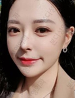 -韩国BornDi整形外科双眼皮+隆鼻手术前后对比效果