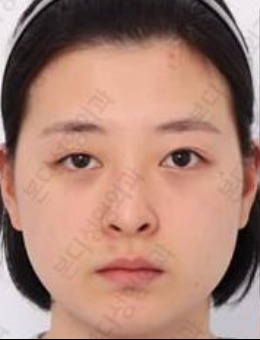 韩国BornDi整形外科双眼皮+隆鼻手术前后对比效果_术前