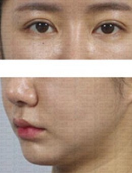 埋线双眼皮+开眼角+祛黑眼圈+面部吸脂综合整形手术照片