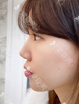 -韩国优雅人整形医院肋骨鼻修复前后对比照片