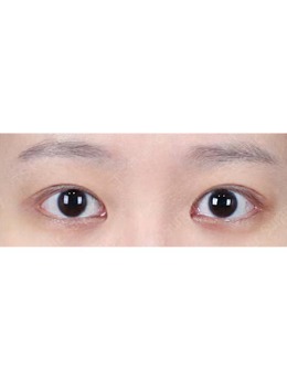 -韩国TS整形医院眼提肌过高眼修复照片