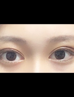 韩国icon整形医院双眼皮手术前后对比图_术后