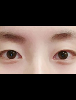 韩国icon埋线双眼皮30天恢复记录变化！_术前