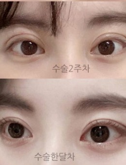 韩国icon埋线双眼皮30天恢复记录变化！_术后