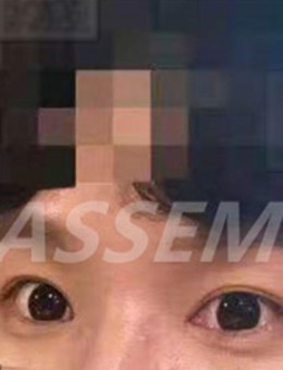 韩国德丽珍整形男士双眼皮全切+提肌+内眼角前后对比图_术后