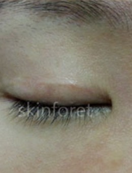 韩国思亲肤乐双眼皮疤痕修复照片