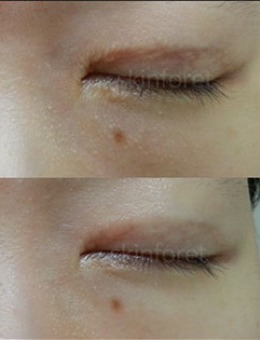 韩国思亲肤乐皮肤科双眼皮疤痕肉条修复前后对比_术后