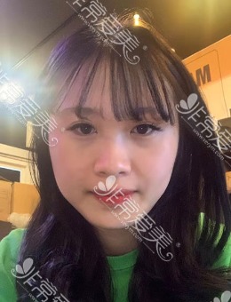 韩国格瑞丝噢爱美医院真人全脸整形分享！项目含眼鼻轮廓脂肪填充！