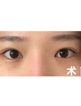 韩国德丽珍全切双眼皮+眼提肌眼角下至对比图