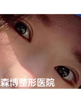 韩国德丽珍全切双眼皮+眼提肌眼角下至对比图