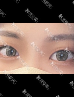 韩国icon整形埋线双眼皮,简单放大眼睛气质超温柔！_术前