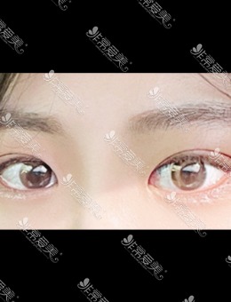 韩国icon整形埋线双眼皮,简单放大眼睛气质超温柔！