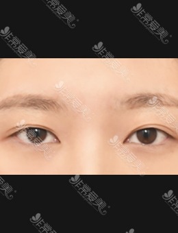 韩国双眼皮修复好的医院分享，ICON医院真人埋线修复改变惊艳！_术前