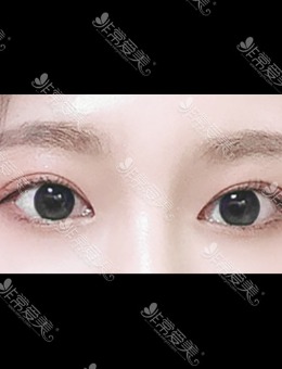 韩国双眼皮修复好的医院分享，ICON医院真人埋线修复改变惊艳！