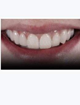 韩国移安曼哈顿牙科牙齿贴片治疗恢复照，改善简直就是绝绝子！