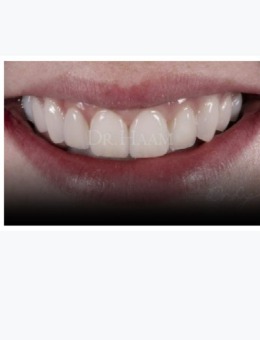 -韩国移安曼哈顿牙科牙齿贴片治疗恢复照，改善简直就是绝绝子！