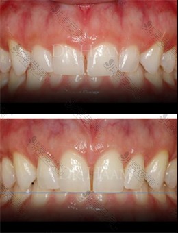 -韩国移安曼哈顿牙科做牙冠延长术前后改善对比！
