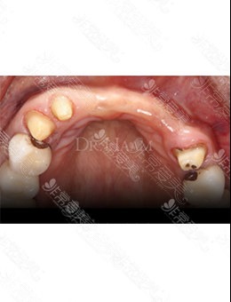 韩国移安曼哈顿牙科“牙骨移植+牙骨再生治疗”图例