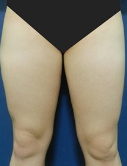 -韩国体引脂整形医院大腿吸脂手术前后对比图