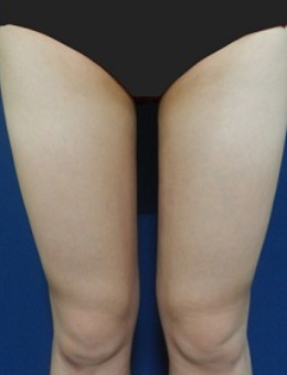韩国体引脂整形医院大腿吸脂手术前后对比图_术后