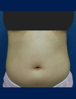 韩国体引脂医院肚子吸脂手术日记图片