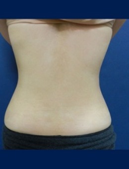 韩国体引脂背部吸脂+腰腹吸脂手术日记