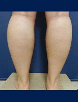 韩国体引脂小腿吸脂手术对比图