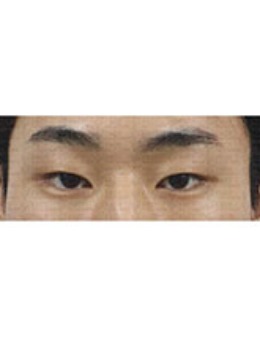 韩国真实整形外科埋线双眼皮(提肌)+上眼角案例