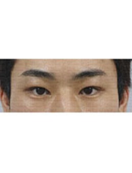 韩国真实整形外科埋线双眼皮(提肌)+上眼角日记