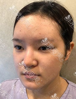 记录韩国TS整形轮廓三件套+眼鼻综合手术1年恢复变化