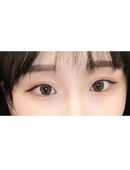 -韩国Yellow整形外科埋线双眼皮+前后眼角手术真人案例