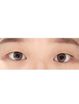 -韩国Yellow整形外科埋线双眼皮+眼角脂肪去除手术效果！