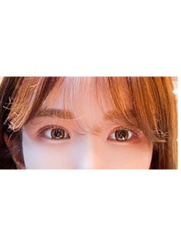 -韩国Yellow整形外科埋线双眼皮+眼尾下至手术效果图
