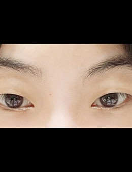 -韩国icon整形双眼皮+取眼内脂肪手术前后对比